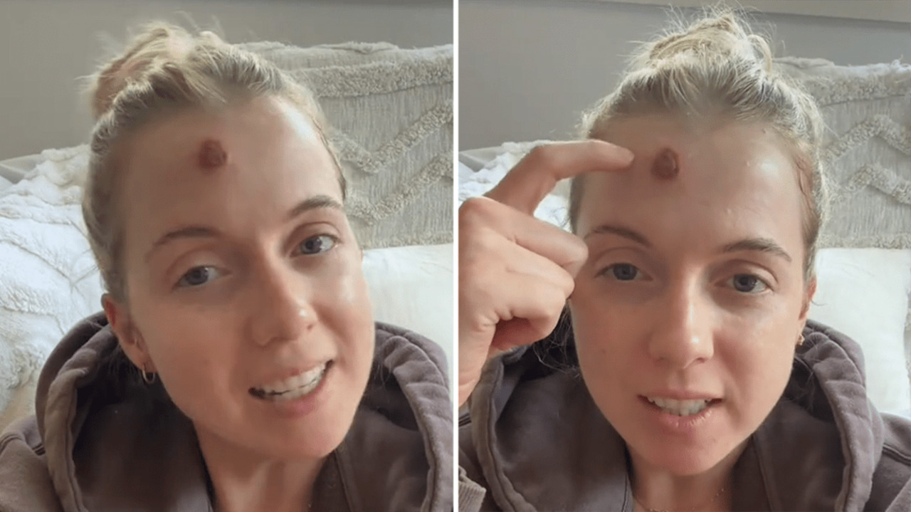 Pimple on Forehead is Cancer