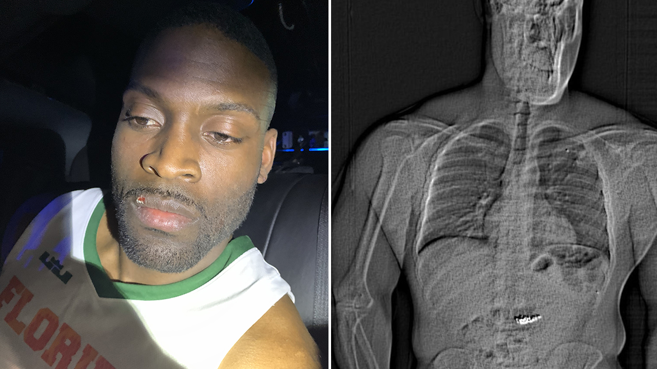 Diamond Earrings Swallowed by Thief