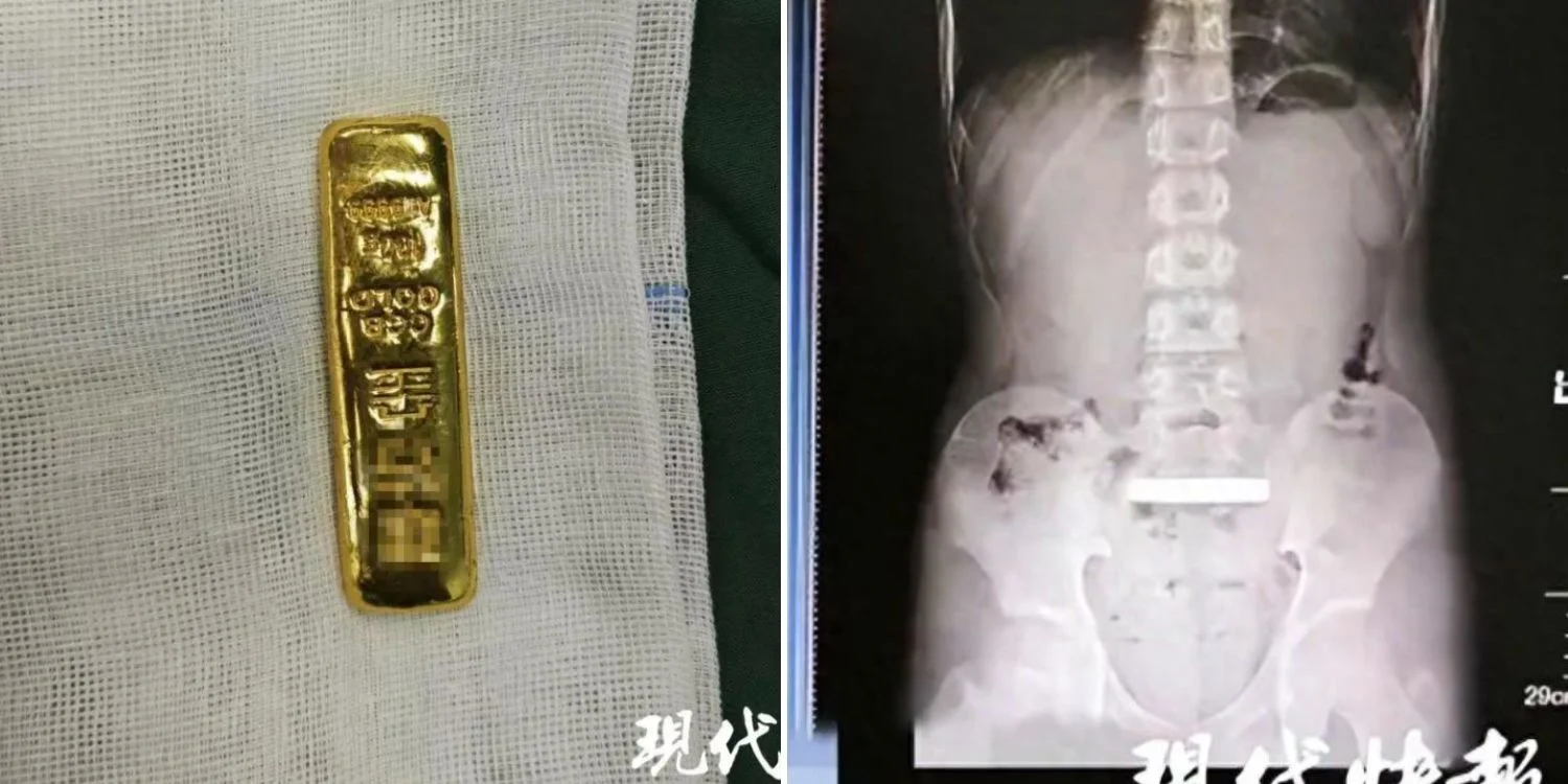 11-Year-Old Boy Swallowed 100-Gram Gold Bar