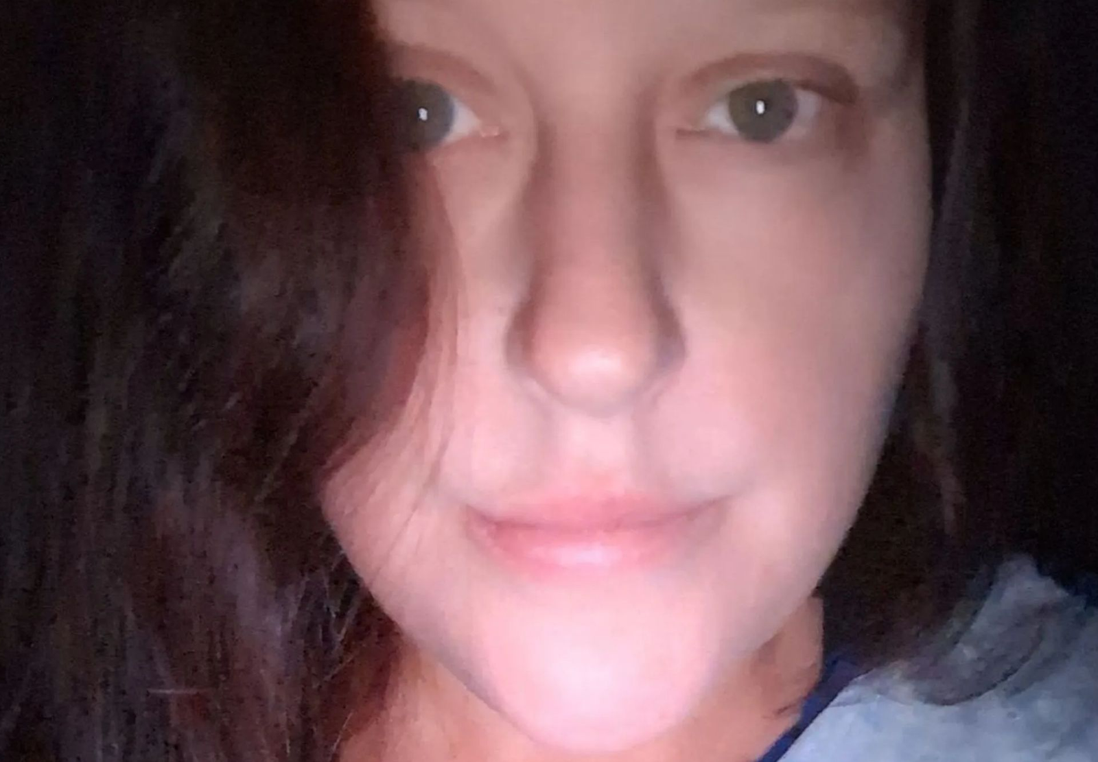 Ingrown Toenail Turned Gangrenous