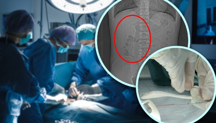 Drunk Man Swallows Spoon